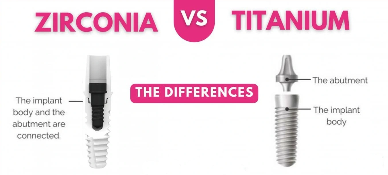 Zirconia Vs Titanium Dental Implants - The Key Differences