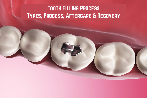 Tooth Filling Process Types Process Aftercare Recovery