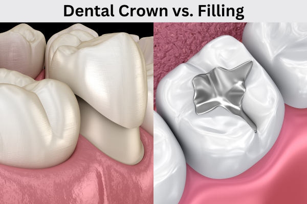 Dental Crown vs. Filling