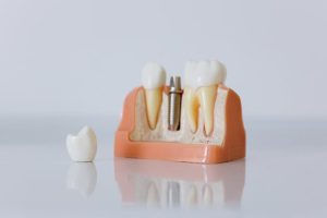 dental implants vs bridge