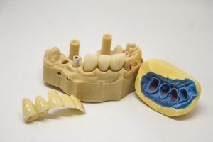 dental bridge procedure guide