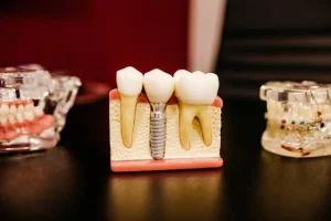 dental implants for missing teeth