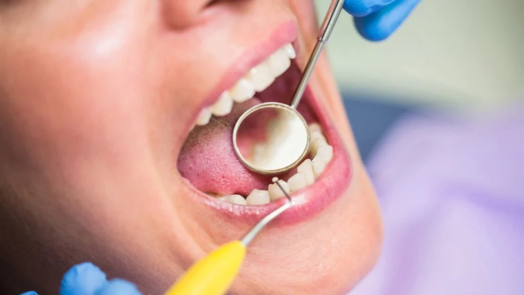 chipped tooth crown